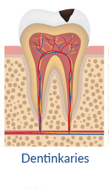 dentinkaries