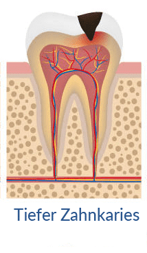 tiefer-zahnkaries