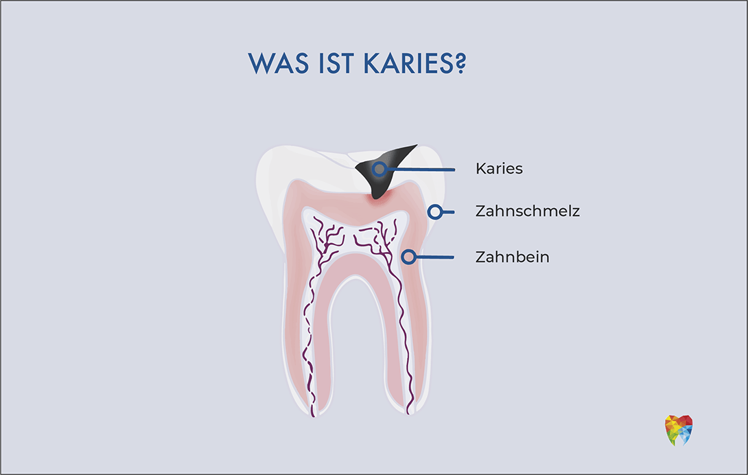was-ist-karies