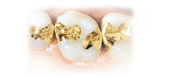 Gold Inlay