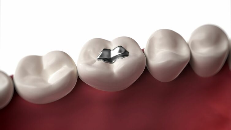 Amalgam Schädlich Header