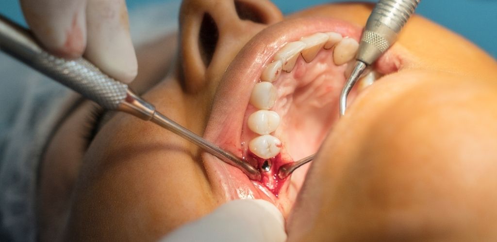 Implantat Schmerzen Behandlung