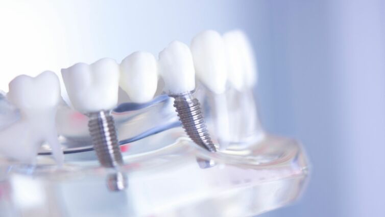 Wie lange haltenWie lange halten Implantate Header Implantate Header