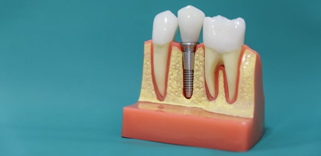 Wie lange halten Implantate Modell