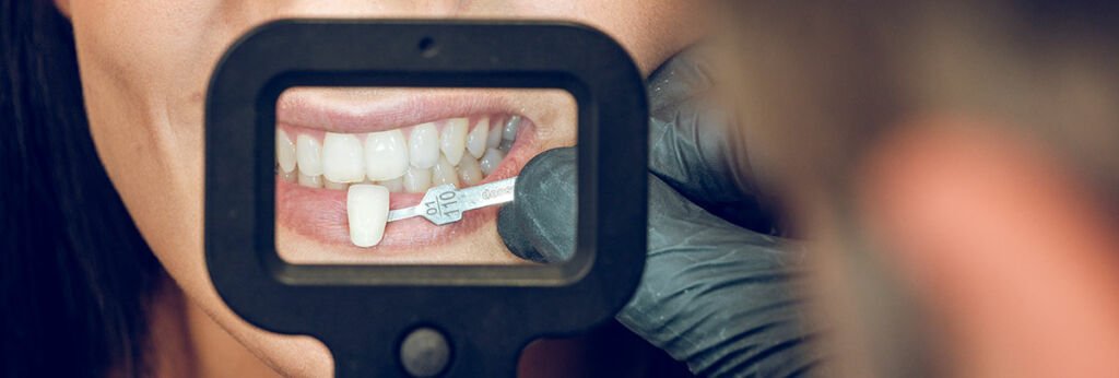 Veneers