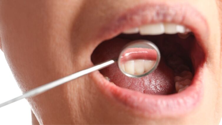 Nahaufnahme eines offenen Mundes während einer zahnärztlichen Untersuchung mit einem Dentalspiegel zur Kontrolle des Zahnfleisches.